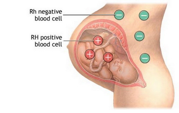 Rh negativna krvna grupa i trudnoća