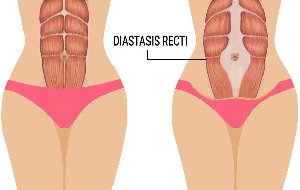 Što je dijastaza i zašto se javlja u trudnoći?