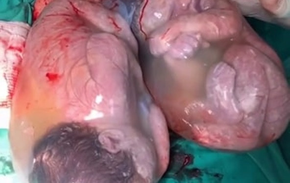 Видео: Близнаци родени во амнионска обвивка