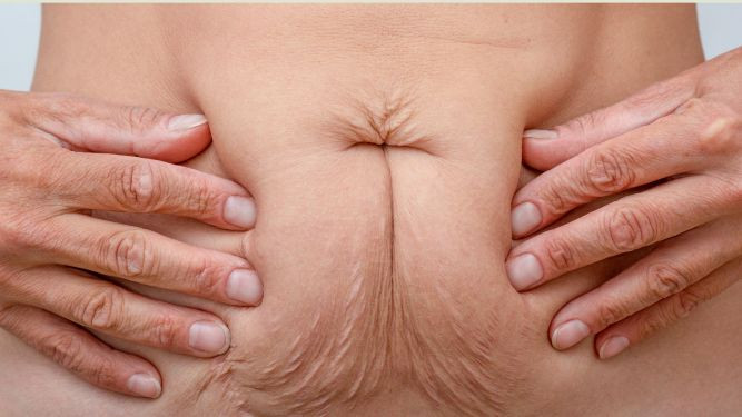 Телото се менува, а кожата треба да добие поддршка