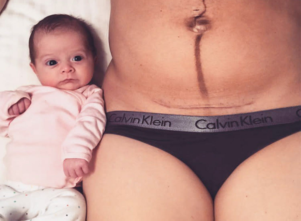 Ta ponosna mama je štiri tedne po porodu delila fotografijo svojega telesa. Njen način opisovanja vaše brazgotine? Vredno je.