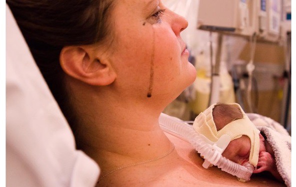 Bol roditelja prerano rođenih beba kroz slike