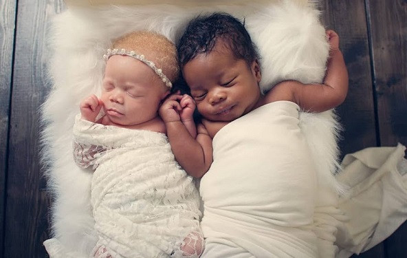 VIDEO: Mama rodila blizance različite boje kože
